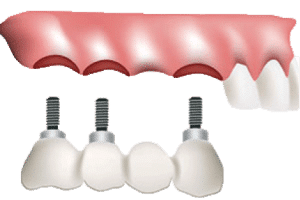 Implant Supported Bridge