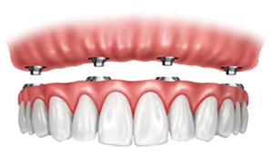 Screw Retained Dentures