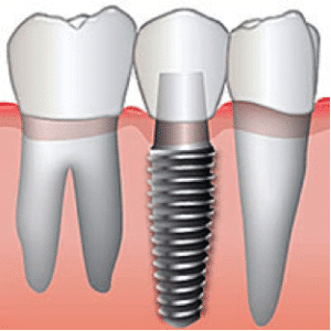 single dental implant